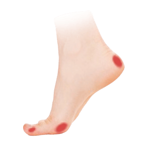 Otlaky, mozoly, kuří oka